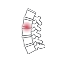 Spondylosis final